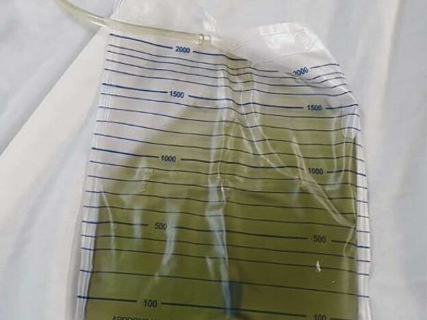 Medical Must-See: Doctors puzzled by grass-green pee