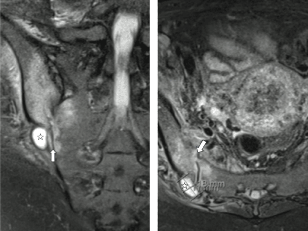 Medical Must-See: Pregnant patient's diagnosis a rare pain in the butt 