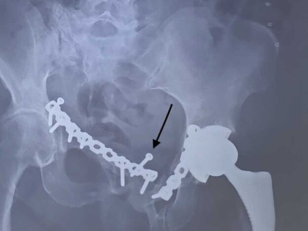 Medical Must-See: Loose screw found in bladder 19 years after pubic bone surgery