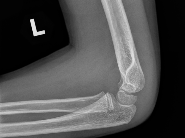 Spot Dx — Can you pick this post-FOOSH injury?