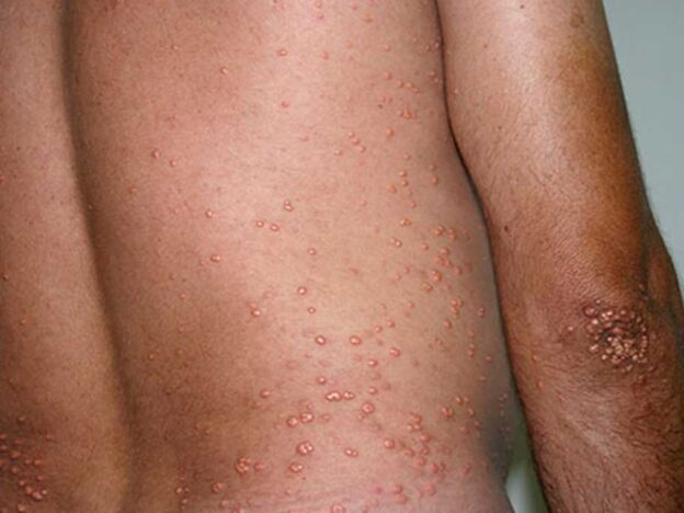 Spot Dx — What are these papules pointing to?