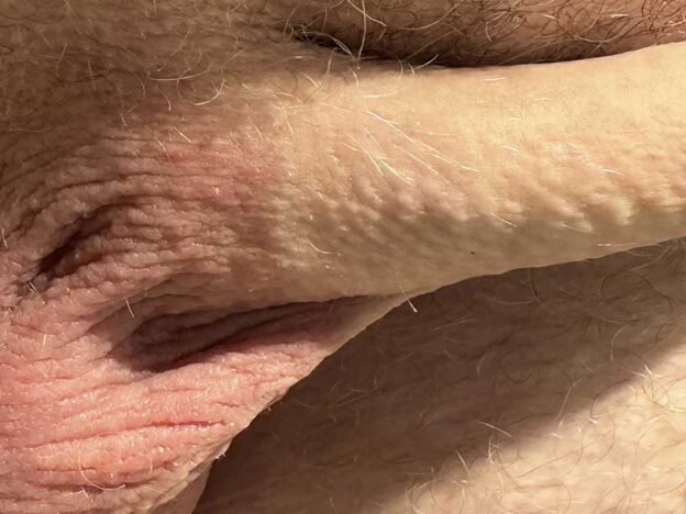 Spot Dx — Do these papules point to an STI?