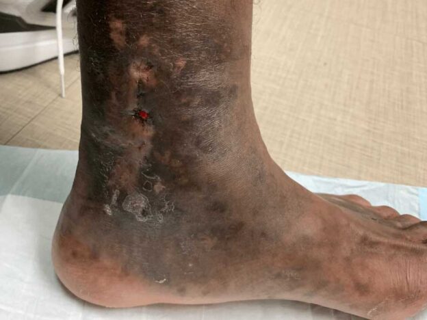 Medical Must-See: What's wrong with this former athlete's foot?