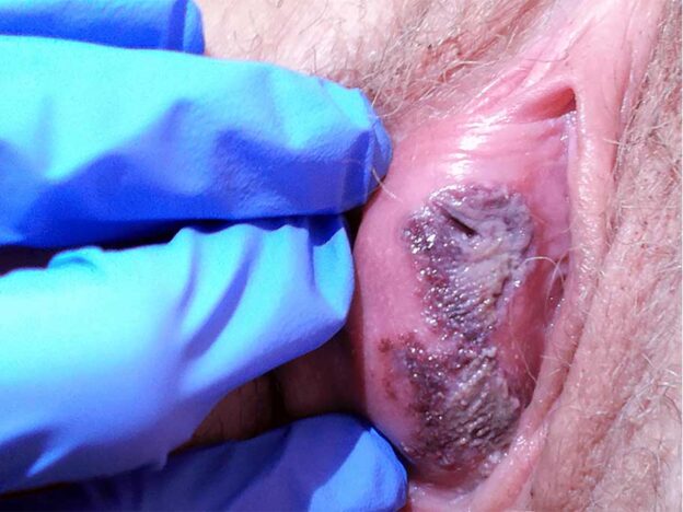 Spot Dx — Can you identify these genital ulcers?