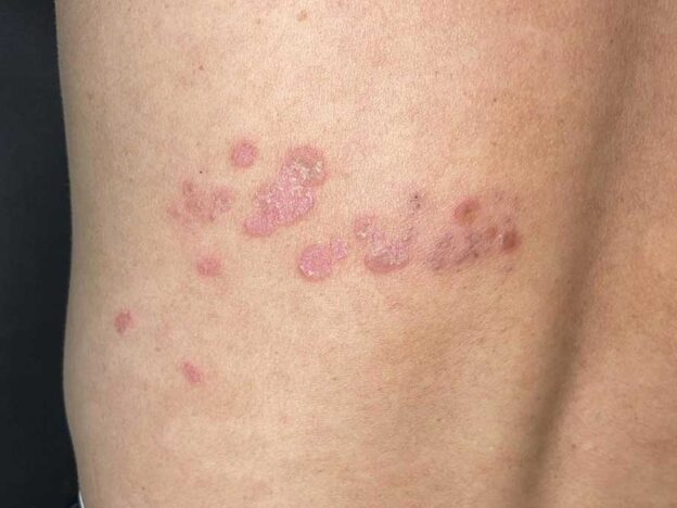 Spot Dx — What are these painless plaques post-shingles?