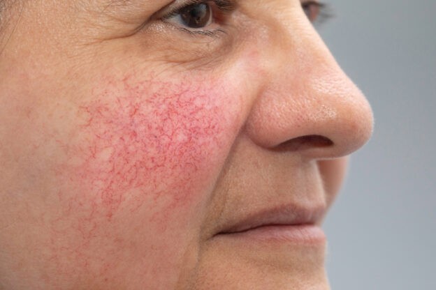 Spot the signs: mastering rosacea diagnosis in general practice