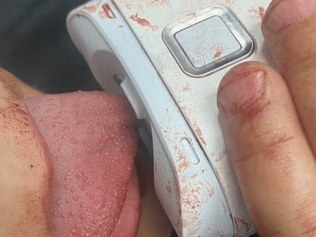 Medical Must-See: Doctors rescue boy's tongue from electric nail clipper