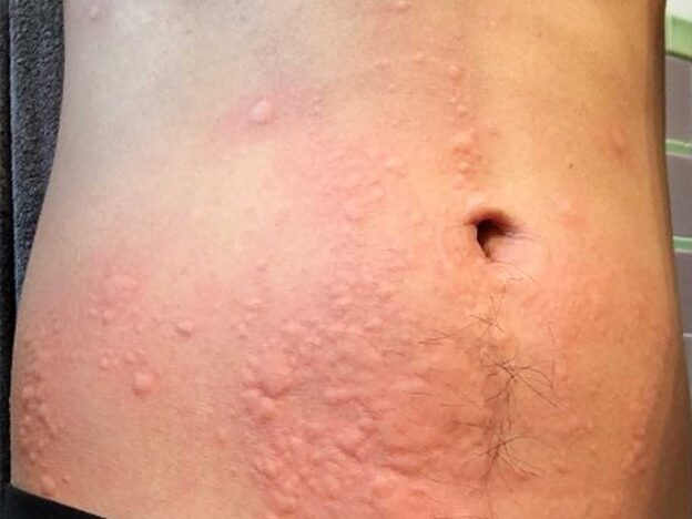 Spot Dx — What's this rash on the tum after a run?