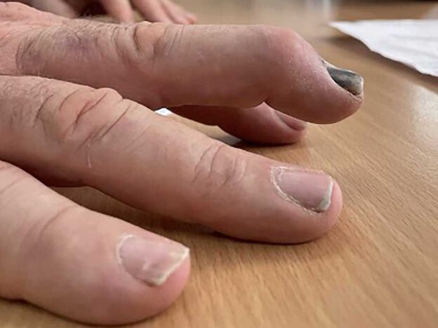 Spot Dx — Can you hit this nail injury on the head?