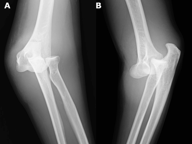 Medical Must-See: How a simple elbow dislocation led to fasciotomy six hours later