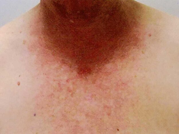 Spot Dx — What's behind this eight-year-old rash?