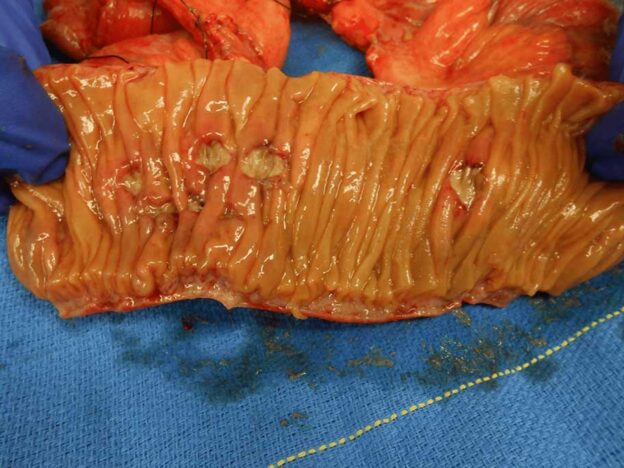 Medical Must-See: Doctors unpeel bowel obstruction case