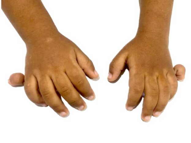 Medical Must-See: Toddler's postaxial polydactyly of the bilateral hand