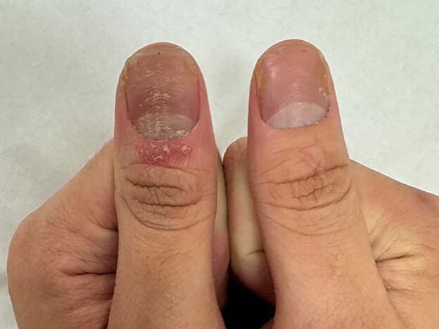 Spot Dx — Can you nail down the cause of these dermatologic changes?