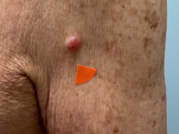 Spot Dx — Can you name this solitary nodule?