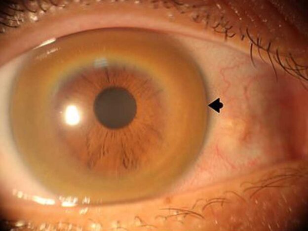 Spot Dx — Do these brown rings catch your eye?