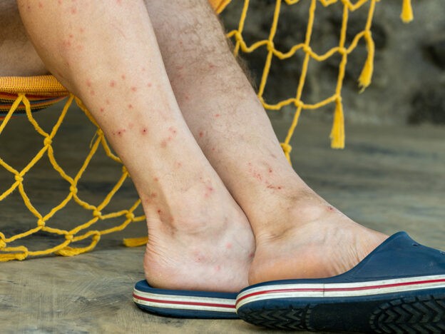 'Insidious onset of symptoms': Holiday sandfly bite triggers rare parasitic disease two years later