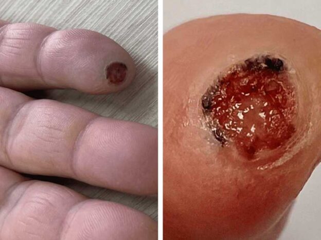 Medical Must-See: A fingertip lesion that’s not bleeding obvious