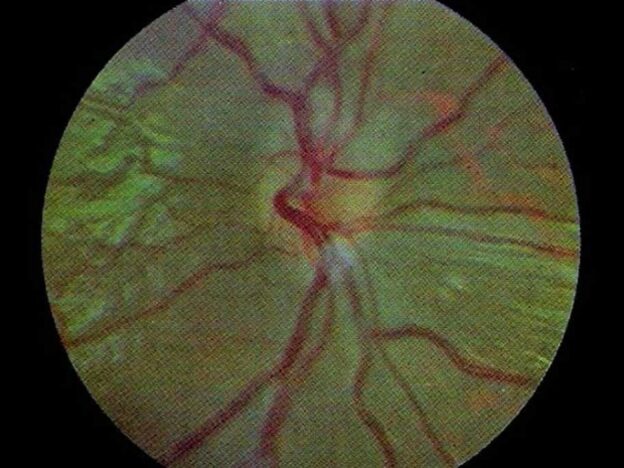 Spot Dx — What's behind this blurred vision?