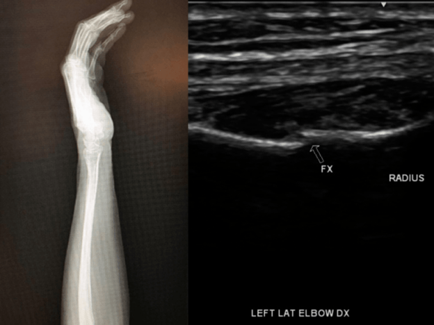 Suspect a stress or rib fracture? An ultrasound referral may be the best option