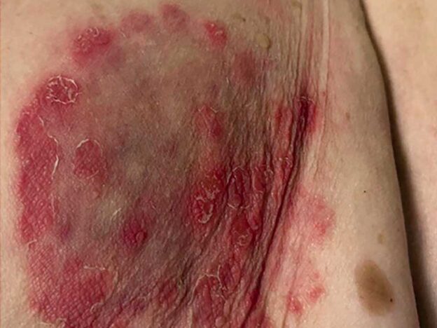 Spot Dx — What's round, red and itching all over?