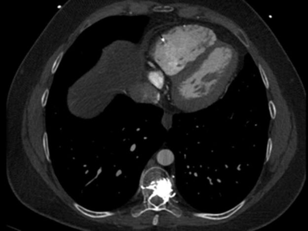 Medical Must-See: A heavy heart or cardiac cement emboli?