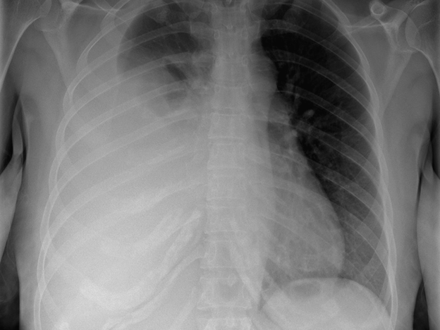 Spot Dx — Why so short of breath after IVF?