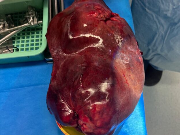 Medical Must-See: Australian surgeon removes 2kg hepatocellular carcinoma