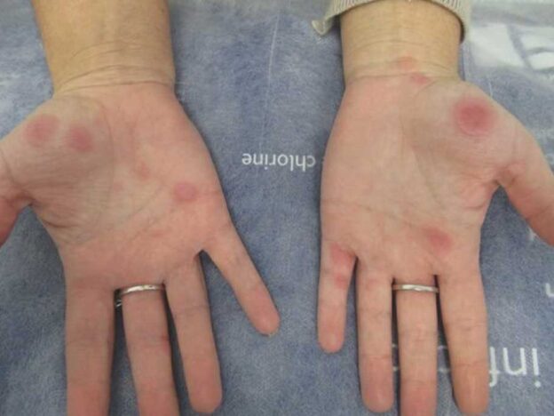 Spot Dx — What is causing these palmar patches?