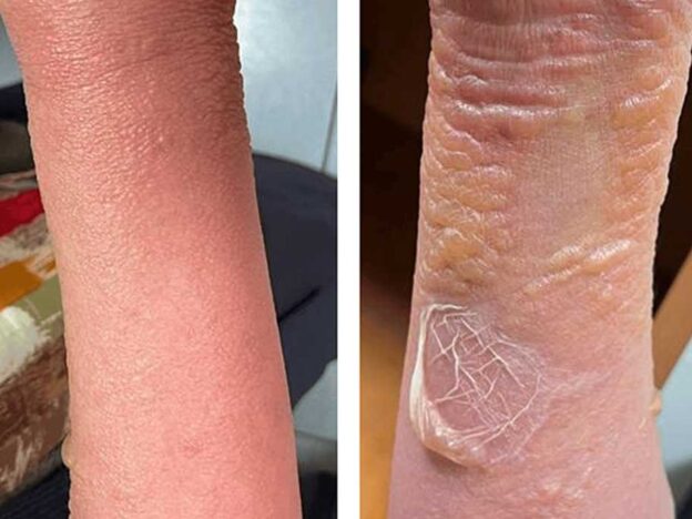 Spot Dx — Can you cast some light on this severe itching?