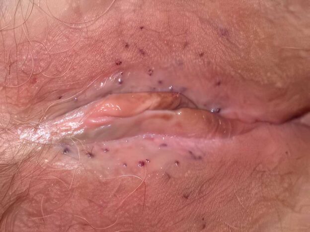 Spot Dx — What's behind this vulval rash?