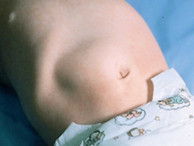 Spot Dx — What's this bub's abdominal mass?