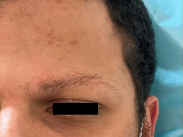 Spot Dx — A teen's thinning hair raises eyebrows