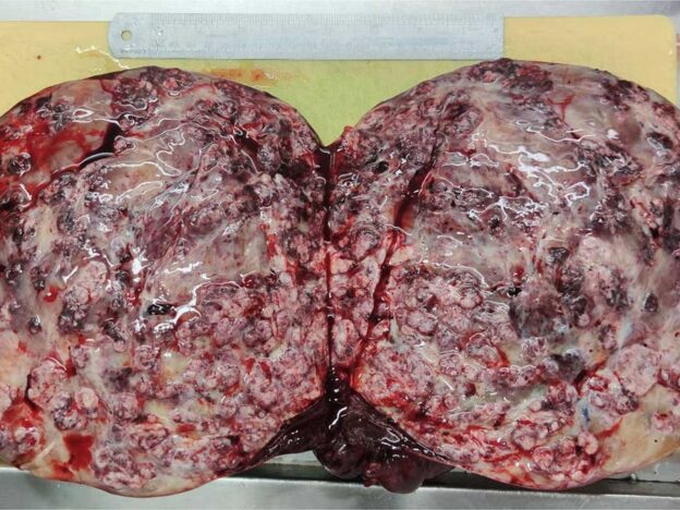 Medical Must-See: Doctors cut out and cut open a 5kg myxoid ovarian tumour