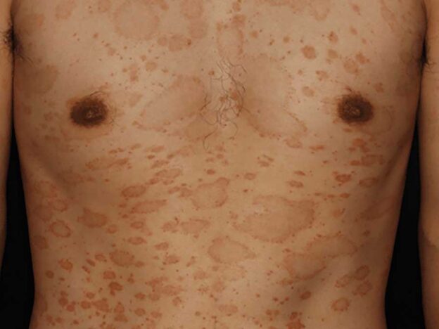 Spot Dx — What's causing this festive-looking rash?