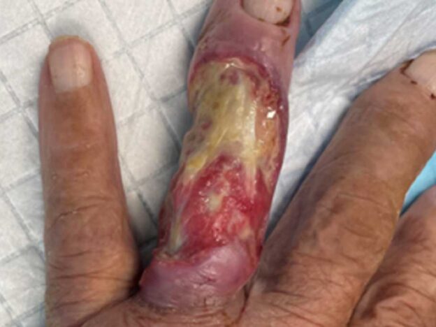 Medical Must-See: Trapped finger points to rare Buruli ulcer diagnosis